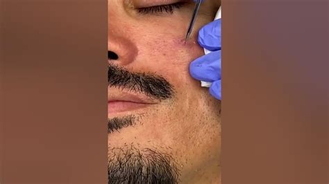 blackheads loan